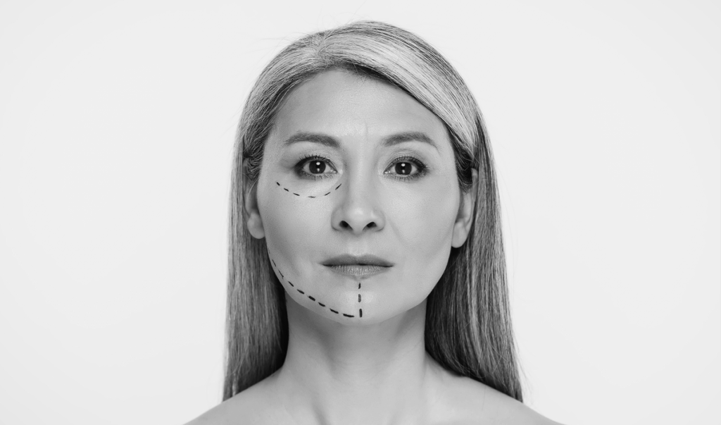 facelift and naturalness