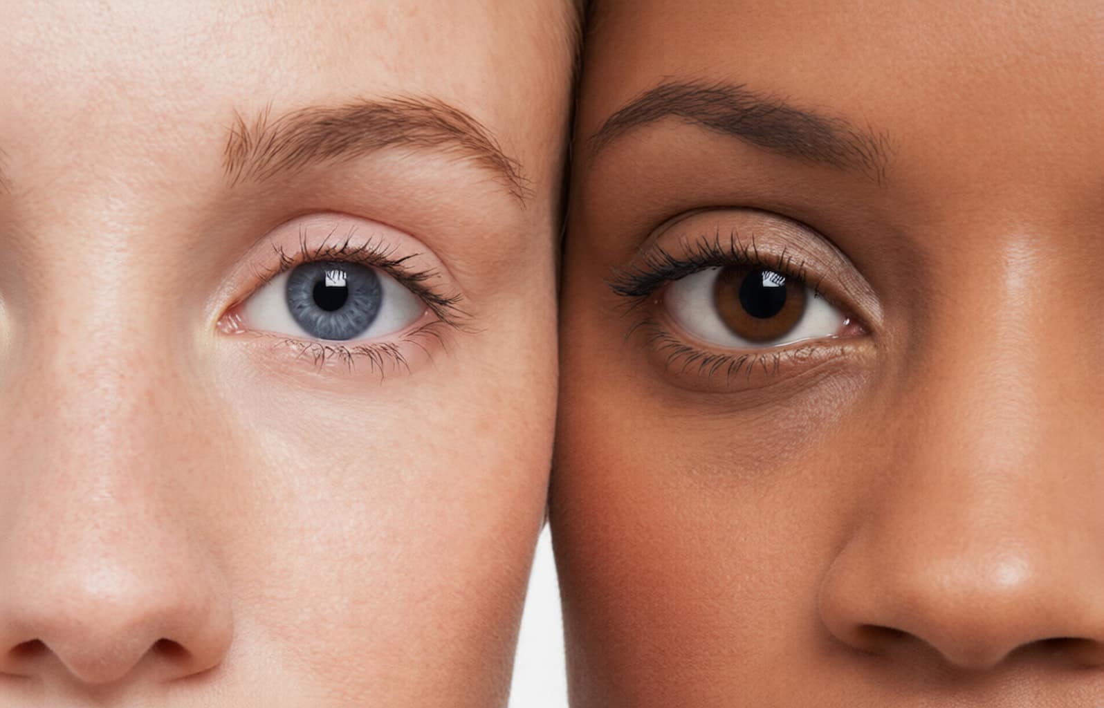 tipos de ojeras